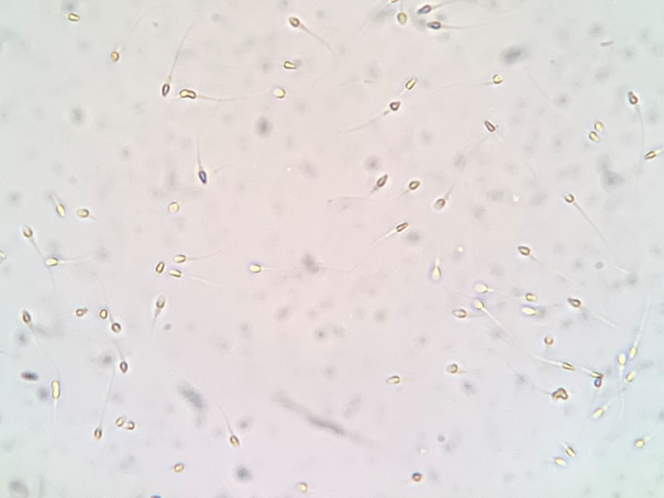 高齡的男性精蟲是否容易造成染色體套數異常的胚胎？的第1張圖片