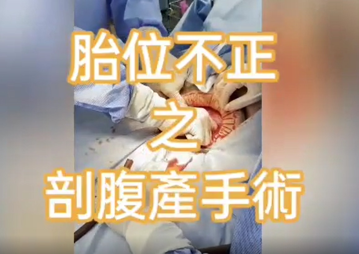 胎位不正之剖腹產手術全紀實的第1張圖片
